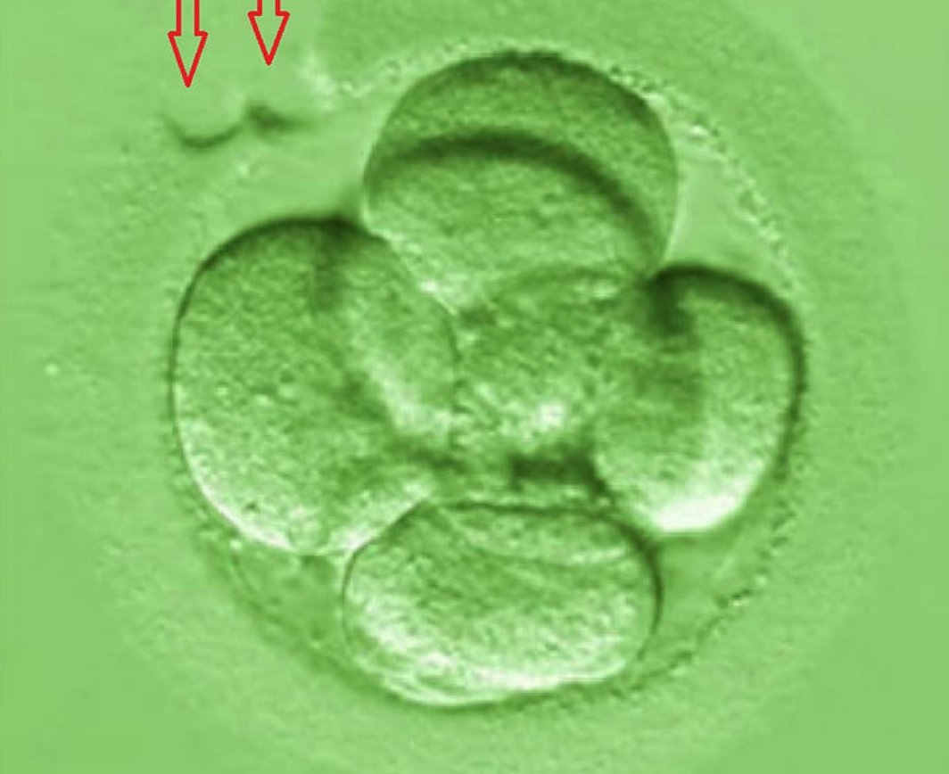 Assisted Hatching (AHA)Zar İnceltme