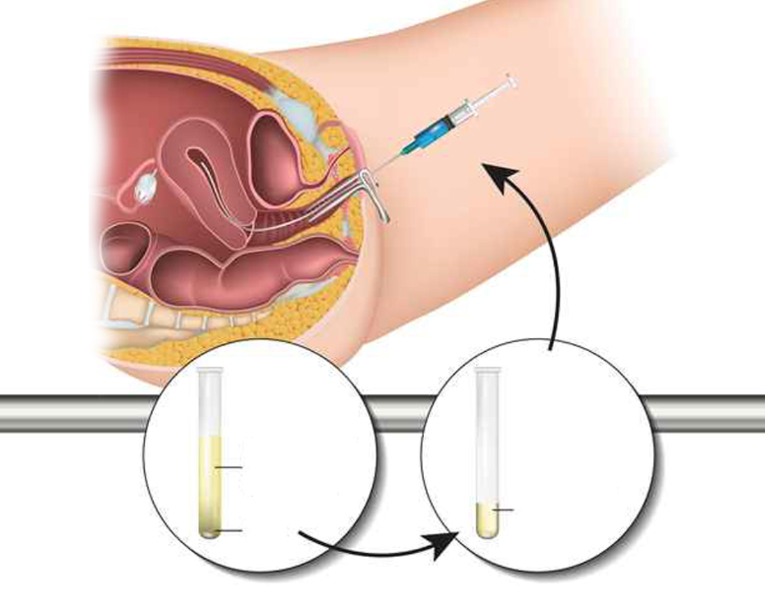 Aşılama (IUI) İntra Uterin İnseminasyon